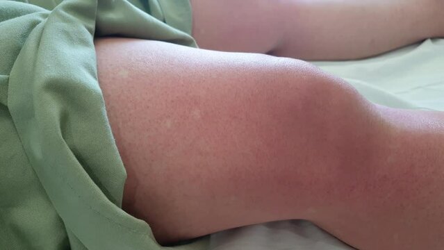 Skin of Dengue fever patient blood red spots under skin mosquitoes tropical disease