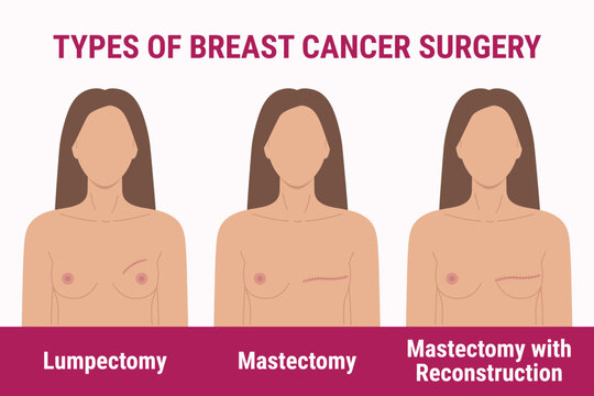 Types of breast cancer surgery lumpectomy, mastectomy, reconstruction. Medical illustration of women chest with scar after surgery. Breast Cancer Awareness Month. Women health care