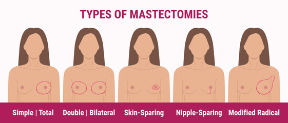Types of mastectomy double, skin-sparing, nipple-sparing, total. Breast removal surgery. Medical illustration of women chest with scar after surgery. Breast Cancer Awareness Month. - obrazy, fototapety, plakaty