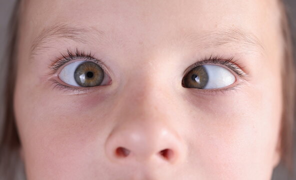 Child's face with squint and freckles on nose. Strabismus in children causes and treatment concept