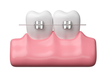 Dental braces and gums, 3D rendering.