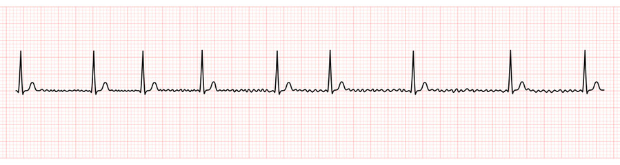 EKG Monitor Showing Atrial Fibrillation With Normal Ventricular Response