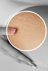 A woman after weight loss shows stretch marks on the skin of her legs and the outer and inner side of the thighs. Treatment of skin stretch marks in the clinic.