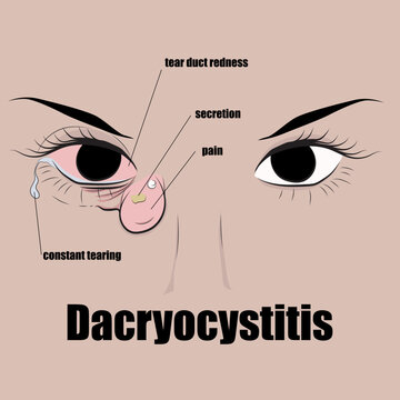 Dacryocystitis is infection of the lacrimal sac, which sometimes leads to abscess formation.