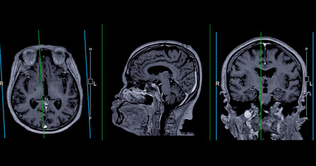 MRI  brain scan Axial , Coronal and sagittal view with referance line for detect  Brain  diseases sush as stroke disease, Brain tumors and Infections.