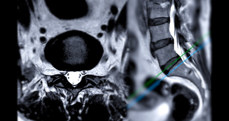 MRI L-S spine or lumbar spine Axial and sagittal T2 technique with reference line  for diagnosis...