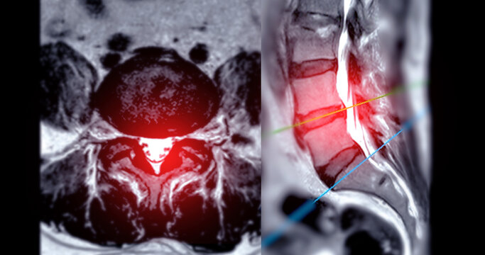 MRI L-S spine or lumbar spine Axial and sagittal T2 technique with reference line  for diagnosis spinal cord compression.