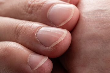 Macro photo of vertical ridges in fingernails