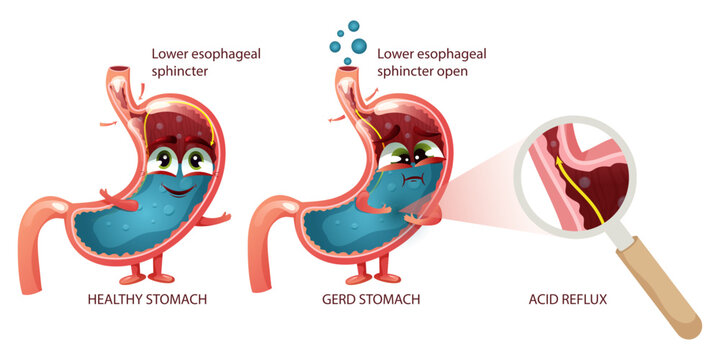 Stomach cartoon characters healthy and GERD with faces and emotions