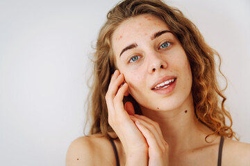 Fototapeta premium Close-up portrait of a beautiful woman without makeup with imperfect skin. Acne skin. Natural beauty. Medicine and cosmetology.