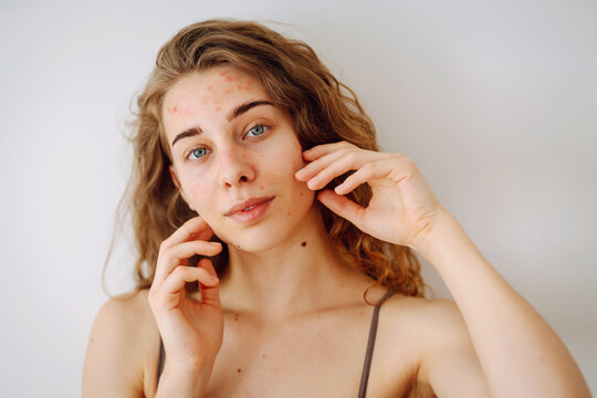 Close-up Portrait Of A Beautiful Woman Without Makeup With Imperfect Skin. Acne Skin. Natural Beauty. Medicine And Cosmetology.