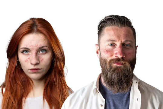 couple of a boy and a girl suffering from ane rosacea, isolated on white background