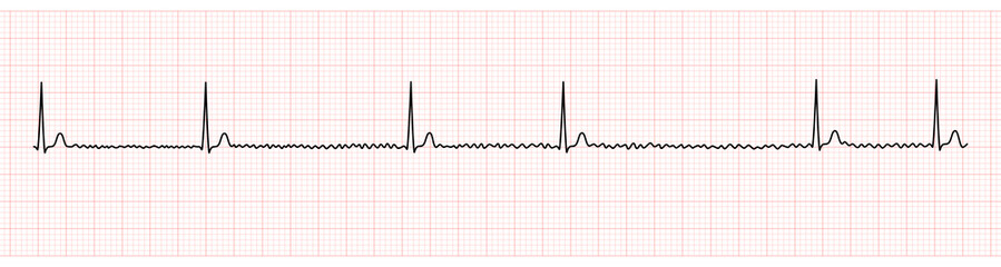 EKG Monitor Showing Atrial Fibrillation With Slow Ventricular Response