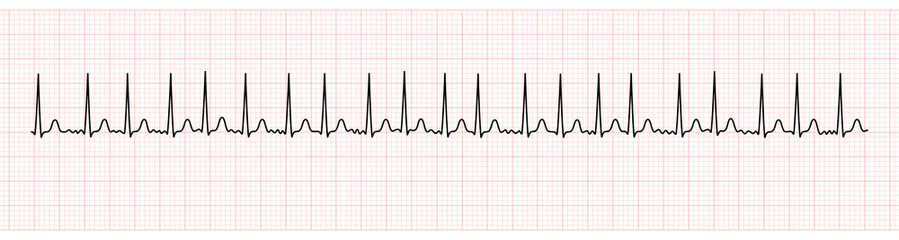 EKG Monitor Showing Atrial Fibrillation With Rapid Ventricular Response - obrazy, fototapety, plakaty
