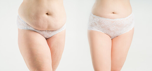 Woman's belly before and after liposuction and weight loss on light gray background, plastic surgery concept