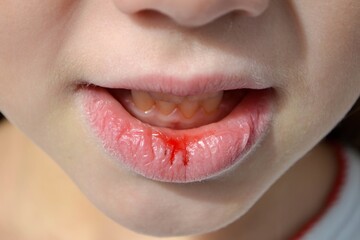 Naklejka premium Dry and damaged lips of a girl