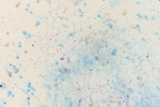 Photomicrograph of Sputum or phlegm smear AFB showing Microbacterium Tuberculosis Bacteria (MTB).