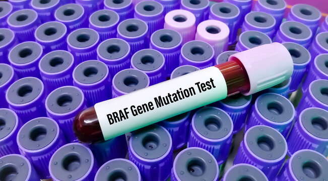 BRAF genetic test to detect the change of tumor that are present in some cancers including metastatic melanoma, lung cancer, colon cancer etc.