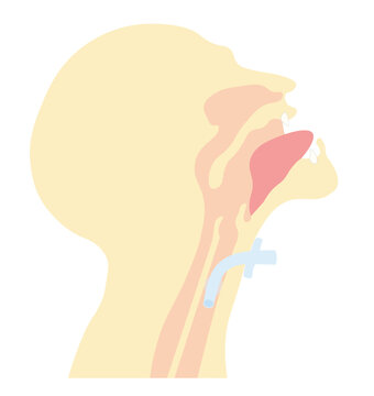 Side View Of A Human Airway Anatomy With A Tracheostomy Tube 