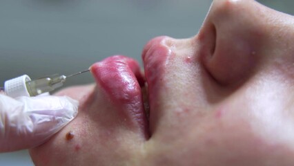 Beautician doctor makes botox injection in the lips of young beauutiful wpman. Extreme close up 4k shot