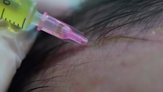 Macro shot of Hair mesotherapy procedure in the modern cosmetology clinic, plasma injectiions. Middle aged male patient prp procedure for hair regrowth