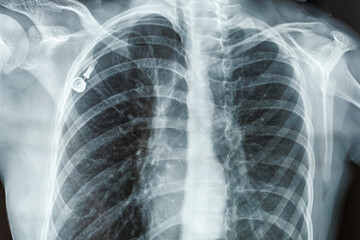 X-ray of a person s lungs and breast with Port Catheter. Virus, cancer or infusion port Insertion screening