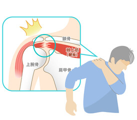 肩腱板断裂の痛みに苦しむ男性