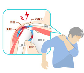 肩関節周囲炎,五十肩の痛みに苦しむ男性