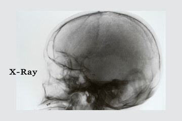  X-ray film of Skull.