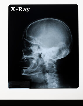 X ray image of human skull