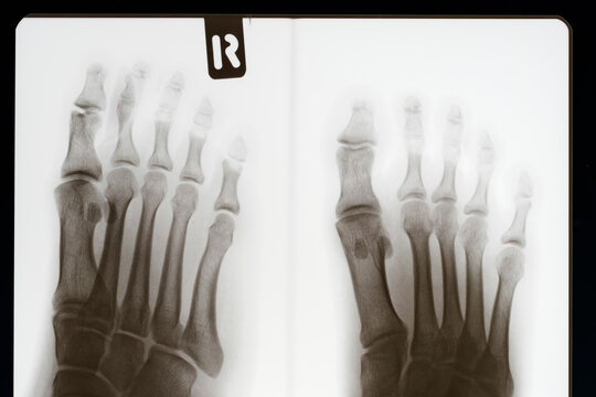 X- ray image of foot.