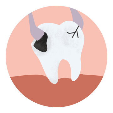 Illustration tooth decay is removed by forceps in oral cavity. toothaches tooth extraction	