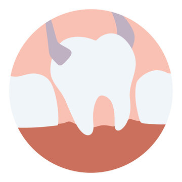 Illustration tooth decay is removed by forceps in oral cavity. toothaches tooth extraction	