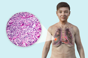 A woman with lung cancer, 3D illustration, and photomicrograph of small cell lung cancer