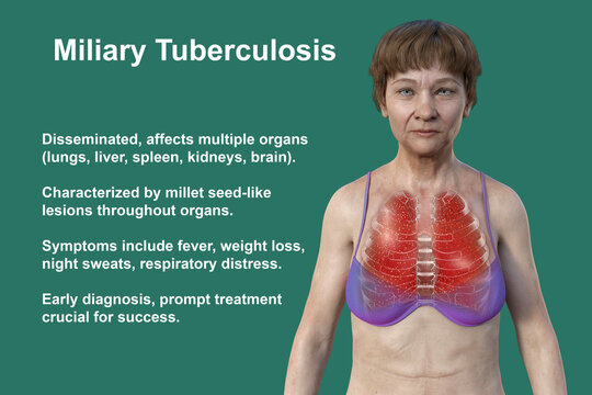 A female patient with lungs affected by miliary tuberculosis, 3D illustration