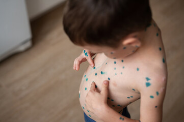 The boy points his finger at the spots on the skin that is cured with brilliant green antiseptic. ...