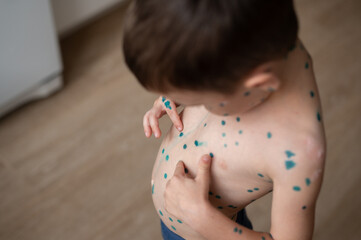 The boy points his finger at the spots on the skin that is cured with brilliant green antiseptic.  Chickenpox or varicella zoster virus. Treatment with brilliant green