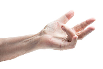 Hand of an old woman with Dupuytren's contracture disease