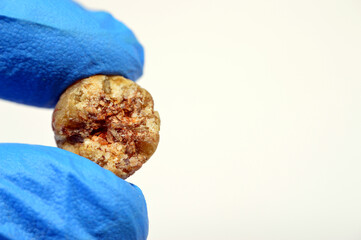 Large gallstone removed surgically after laparoscopic cholecystectomy, Gallstones are hardened...