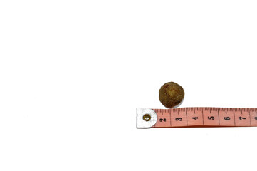 Large gallstone removed surgically after laparoscopic cholecystectomy, Gallstones are hardened...