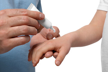Father applying ointment onto his daughter's hand against white background, closeup