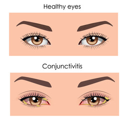 Fototapeta premium Conjunctivitis, eye disease. Medicine flat vector illustration
