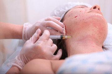 Plasmolifting procedure. Plasmolifting injections in a beauty salon . Cosmetologist's hands....