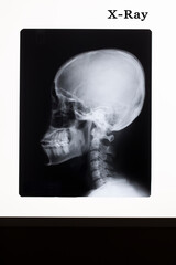 X ray image of human skull.