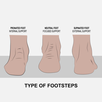 three types of human footprints pronator, supinator and neutral