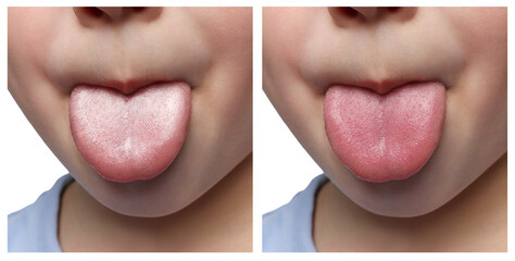 Collage with photos of kid before and after tongue cleaning, closeup
