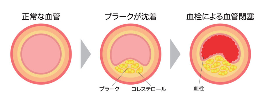 進行する動脈硬化の縦断面図の説明イラスト（横長）