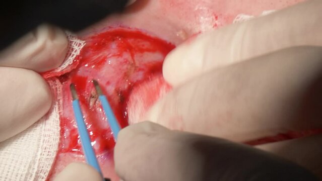 Eyelid Surgery Bleph Cauterize 5