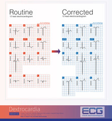 Female, 5-year-old, clinically diagnosed with dextrocardia. The characteristic of dextrocardia electrocardiogram is a gradual decrease in R-wave amplitude from leads V1 to V6.