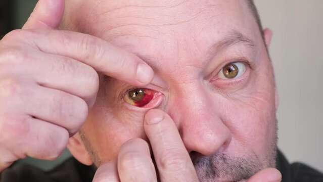 Blood in the eye of a broken blood vessels. Blood pressure. Injury. The eyeball injury from a blow. The adult man looking at the camera and rolling eyes. Impact of stress and fatigue on a human body.
